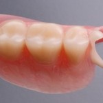 Tooth Colored Clasps